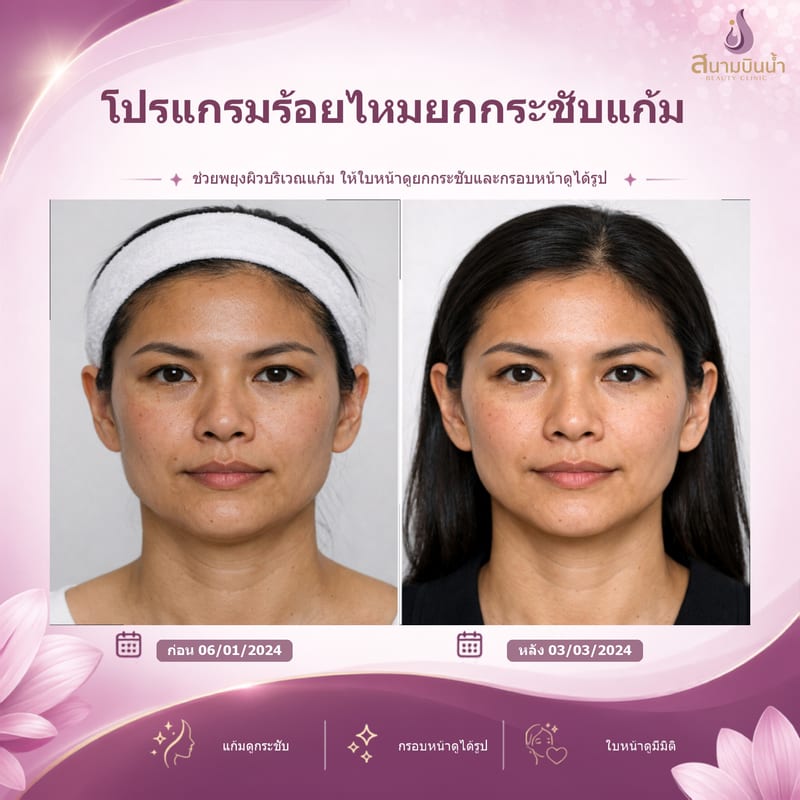ภาพก่อน–หลัง ร้อยไหมแก้ม กรณีเฉพาะบุคคล