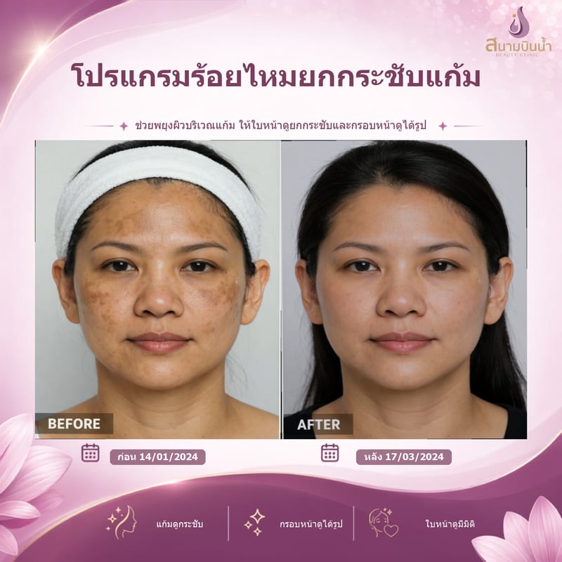 ภาพก่อน–หลัง ร้อยไหมแก้ม กรณีเฉพาะบุคคล