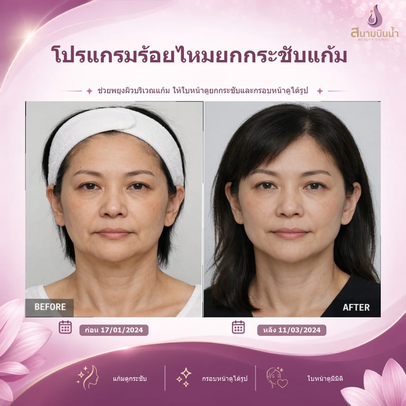 ภาพก่อน–หลัง ร้อยไหมแก้ม กรณีเฉพาะบุคคล