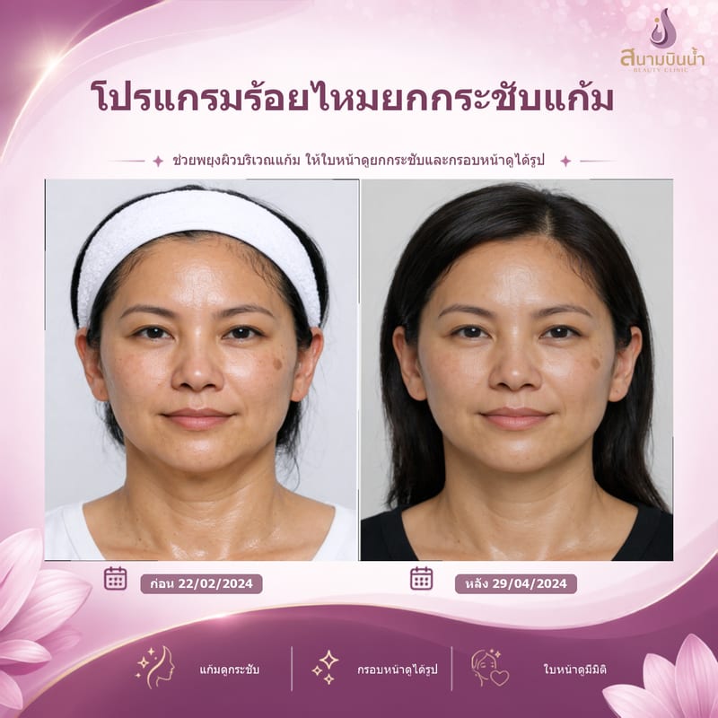 ภาพก่อน–หลัง ร้อยไหมแก้ม กรณีเฉพาะบุคคล