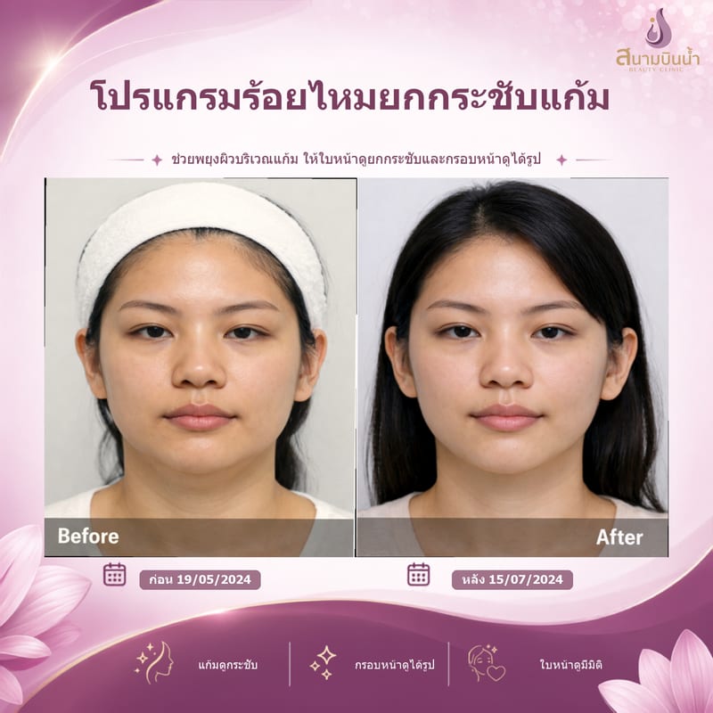 ภาพก่อน–หลัง ร้อยไหมแก้ม กรณีเฉพาะบุคคล