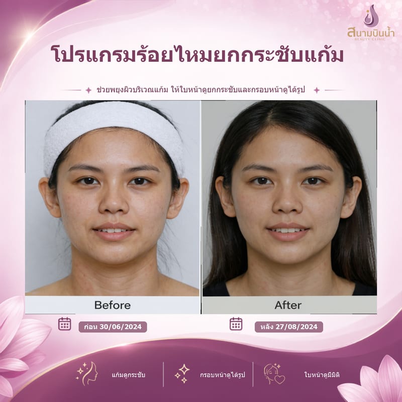 ภาพก่อน–หลัง ร้อยไหมแก้ม กรณีเฉพาะบุคคล