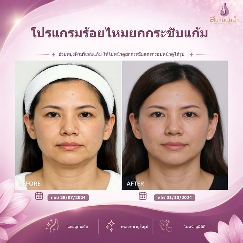 ภาพก่อน–หลัง ร้อยไหมแก้ม กรณีเฉพาะบุคคล