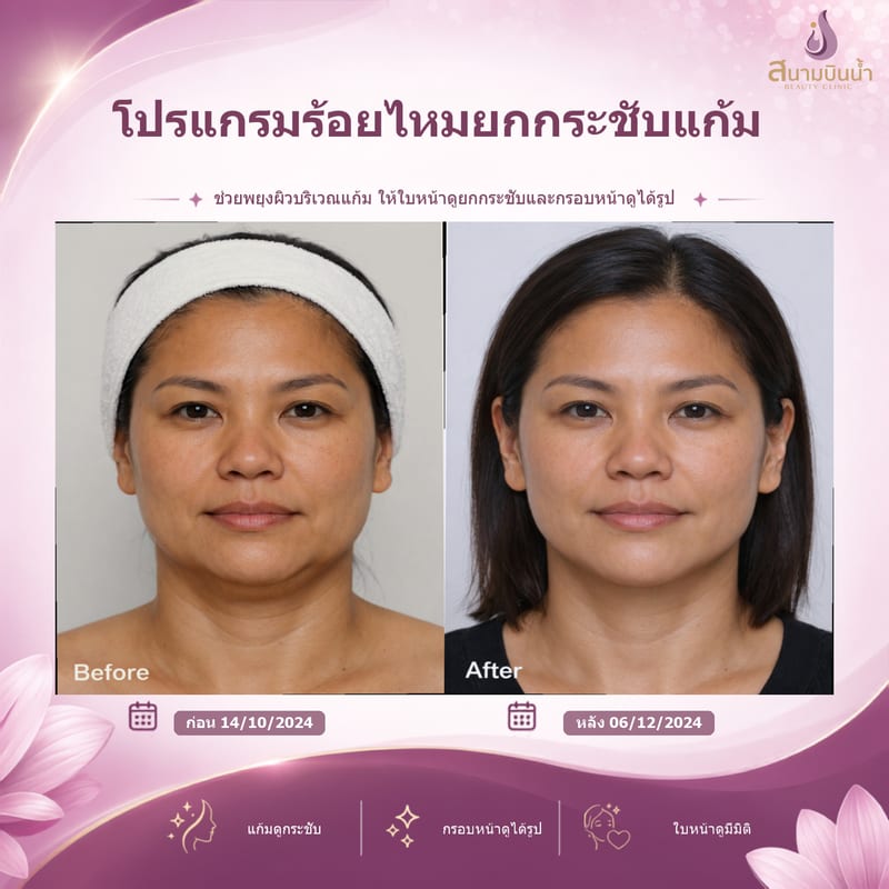 ภาพก่อน–หลัง ร้อยไหมแก้ม กรณีเฉพาะบุคคล