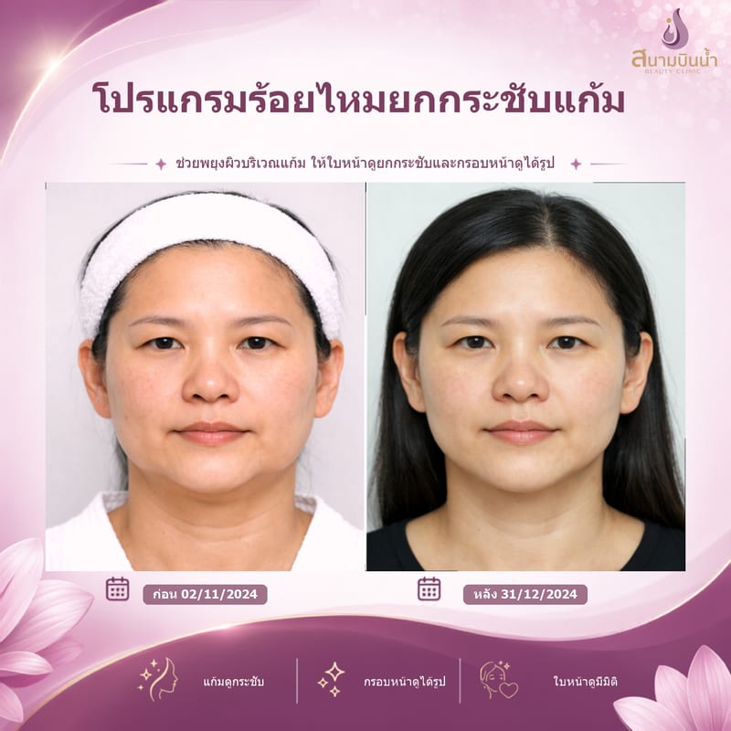 ภาพก่อน–หลัง ร้อยไหมแก้ม กรณีเฉพาะบุคคล