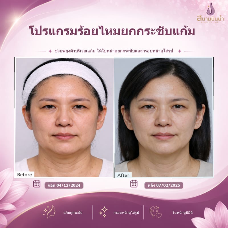 ภาพก่อน–หลัง ร้อยไหมแก้ม กรณีเฉพาะบุคคล