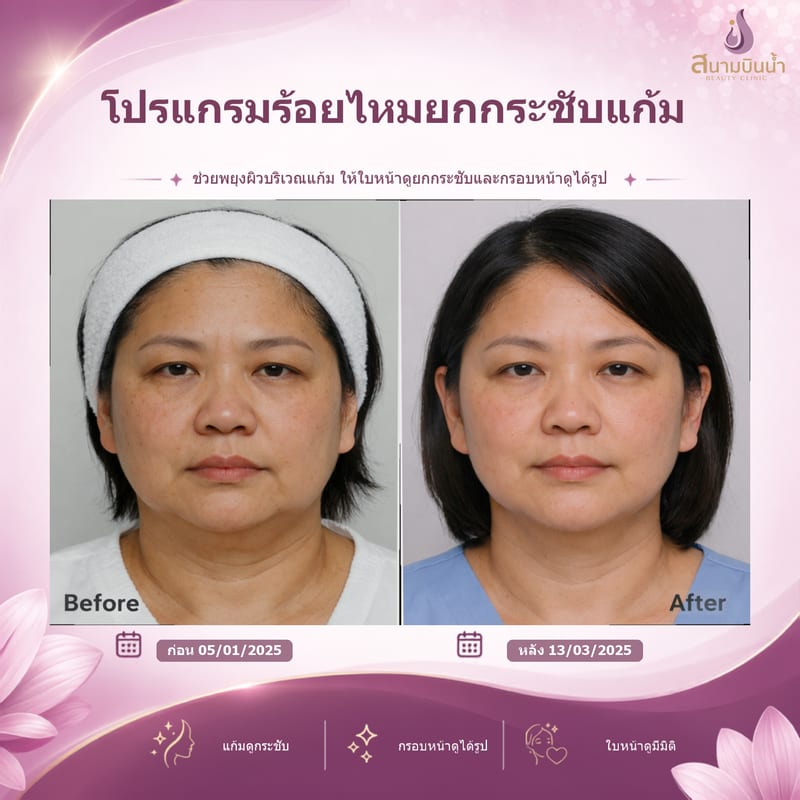 ภาพก่อน–หลัง ร้อยไหมแก้ม กรณีเฉพาะบุคคล
