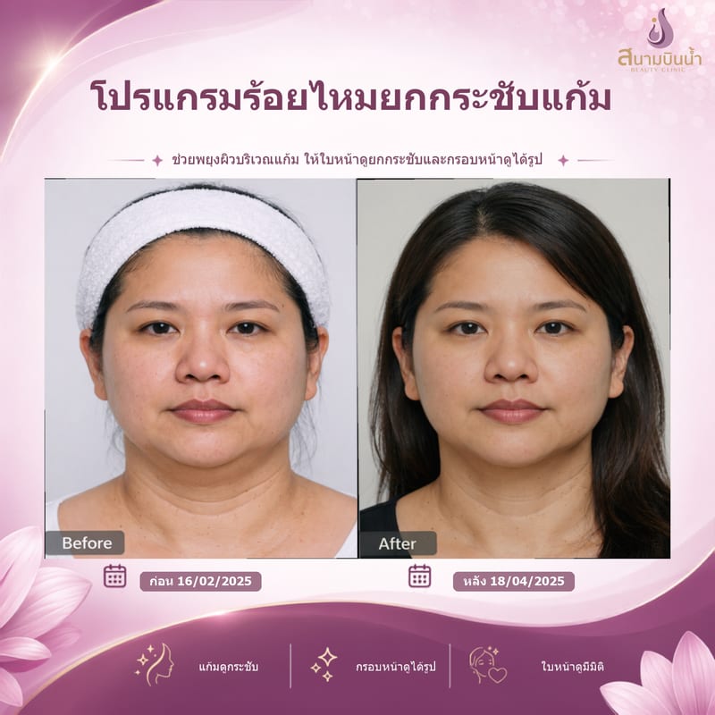 ภาพก่อน–หลัง ร้อยไหมแก้ม กรณีเฉพาะบุคคล