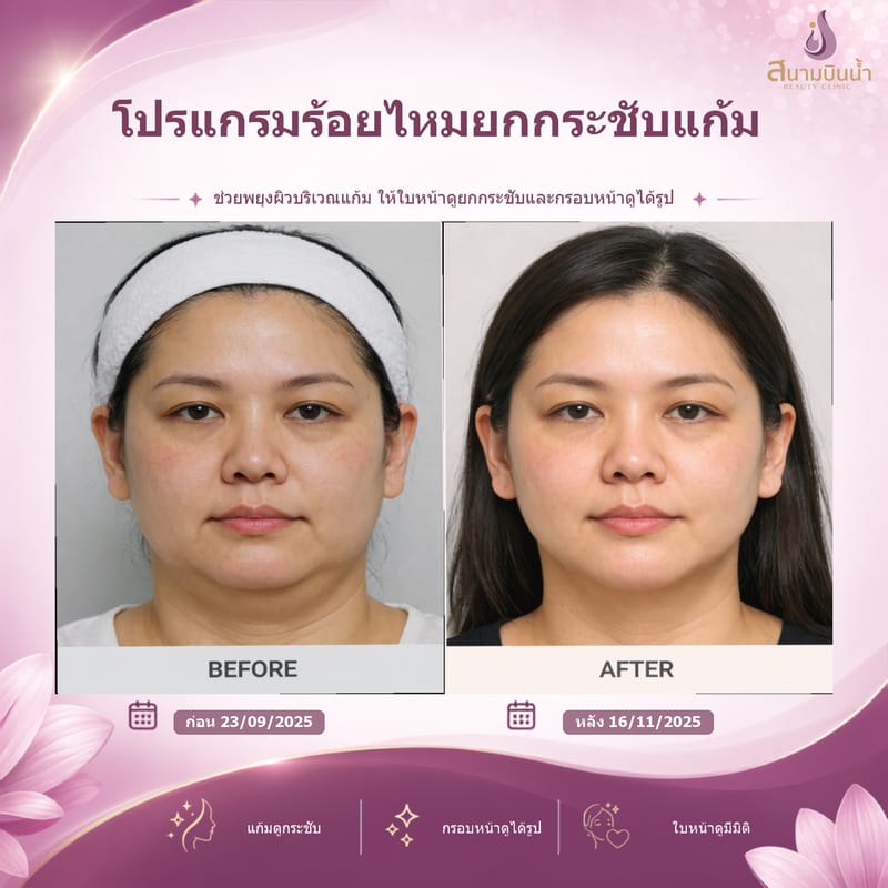 ภาพก่อน–หลัง ร้อยไหมแก้ม กรณีเฉพาะบุคคล