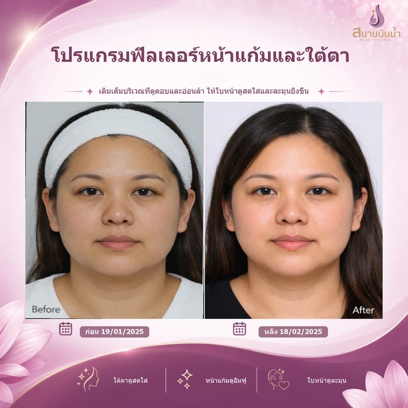 ภาพก่อน–หลัง ฟิลเลอร์หน้าแก้มใต้ตา กรณีเฉพาะบุคคล