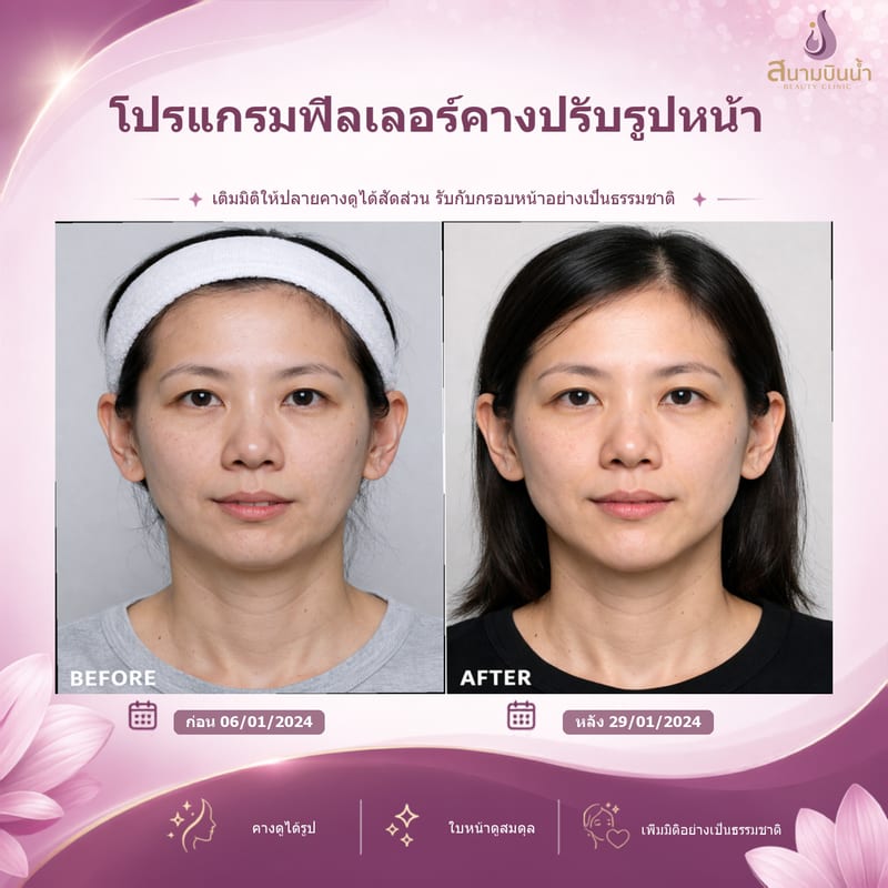 ภาพก่อน–หลัง ฟิลเลอร์คาง กรณีเฉพาะบุคคล