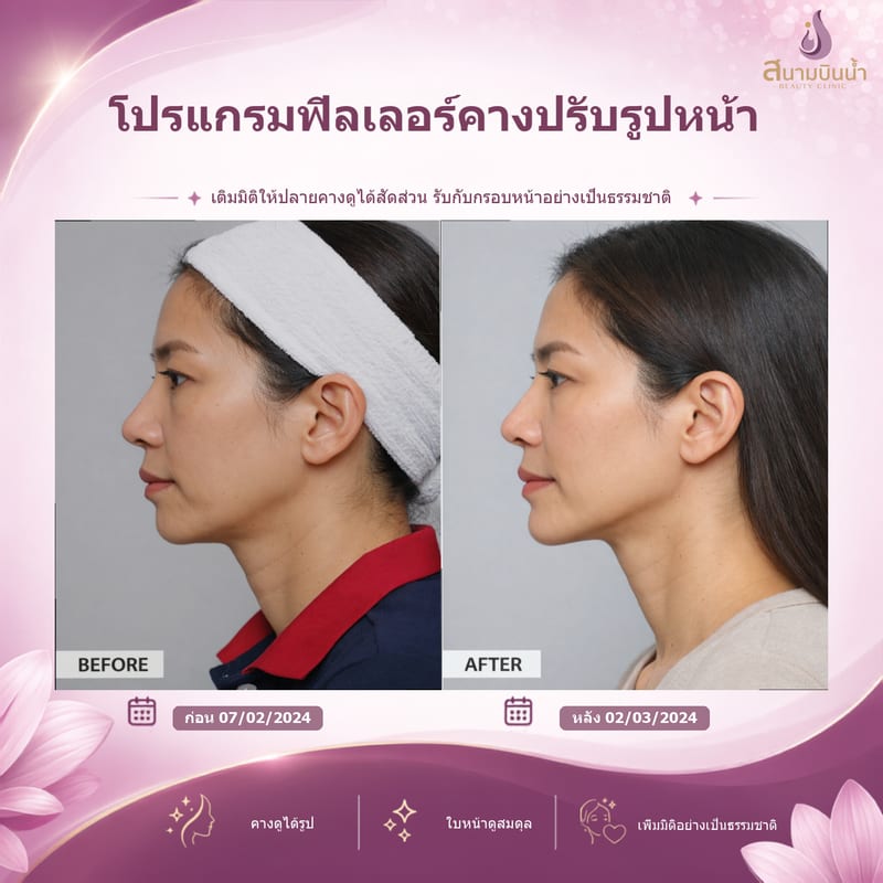 ภาพก่อน–หลัง ฟิลเลอร์คาง กรณีเฉพาะบุคคล