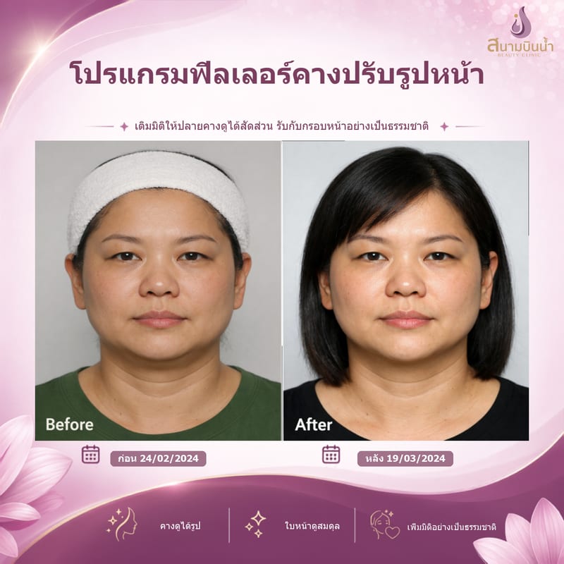 ภาพก่อน–หลัง ฟิลเลอร์คาง กรณีเฉพาะบุคคล