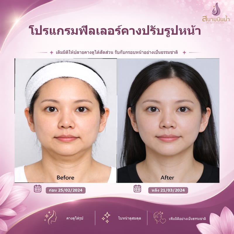 ภาพก่อน–หลัง ฟิลเลอร์คาง กรณีเฉพาะบุคคล