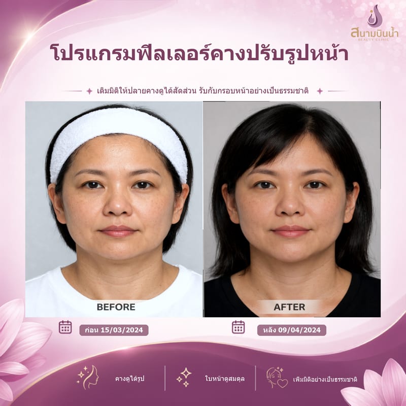 ภาพก่อน–หลัง ฟิลเลอร์คาง กรณีเฉพาะบุคคล