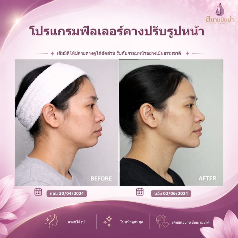 ภาพก่อน–หลัง ฟิลเลอร์คาง กรณีเฉพาะบุคคล