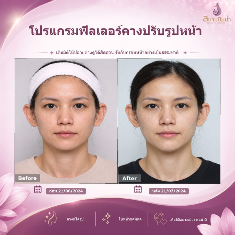 ภาพก่อน–หลัง ฟิลเลอร์คาง กรณีเฉพาะบุคคล
