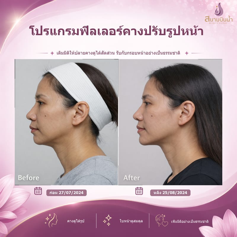 ภาพก่อน–หลัง ฟิลเลอร์คาง กรณีเฉพาะบุคคล