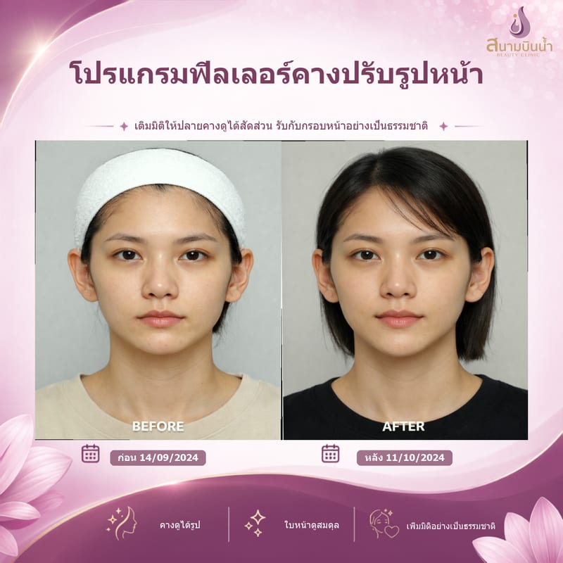 ภาพก่อน–หลัง ฟิลเลอร์คาง กรณีเฉพาะบุคคล