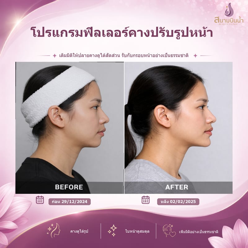 ภาพก่อน–หลัง ฟิลเลอร์คาง กรณีเฉพาะบุคคล
