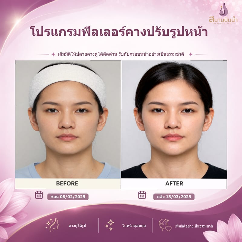 ภาพก่อน–หลัง ฟิลเลอร์คาง กรณีเฉพาะบุคคล