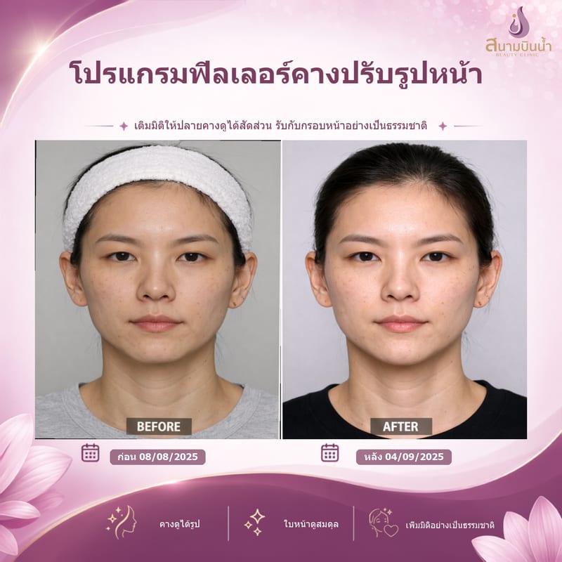 ภาพก่อน–หลัง ฟิลเลอร์คาง กรณีเฉพาะบุคคล