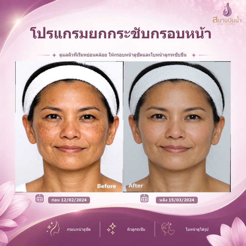 ภาพก่อน–หลัง ยกกระชับกรอบหน้า กรณีเฉพาะบุคคล