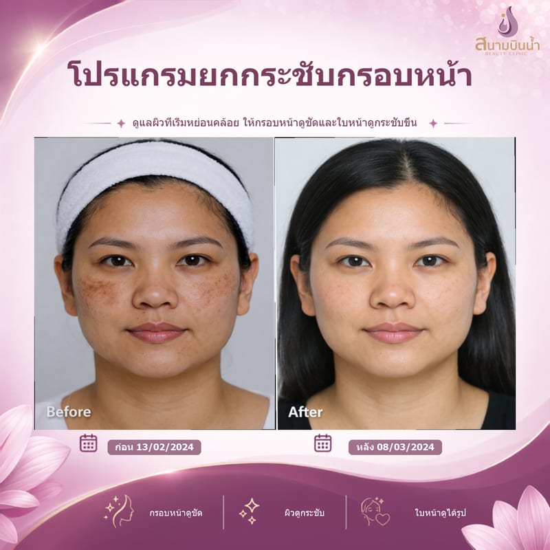 ภาพก่อน–หลัง ยกกระชับกรอบหน้า กรณีเฉพาะบุคคล