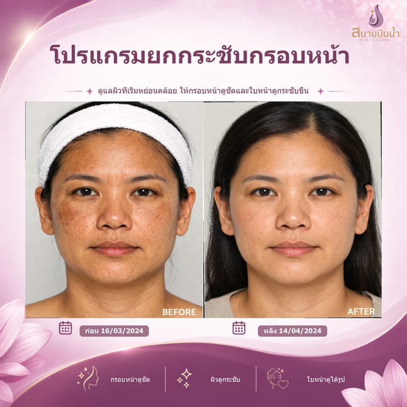 ภาพก่อน–หลัง ยกกระชับกรอบหน้า กรณีเฉพาะบุคคล