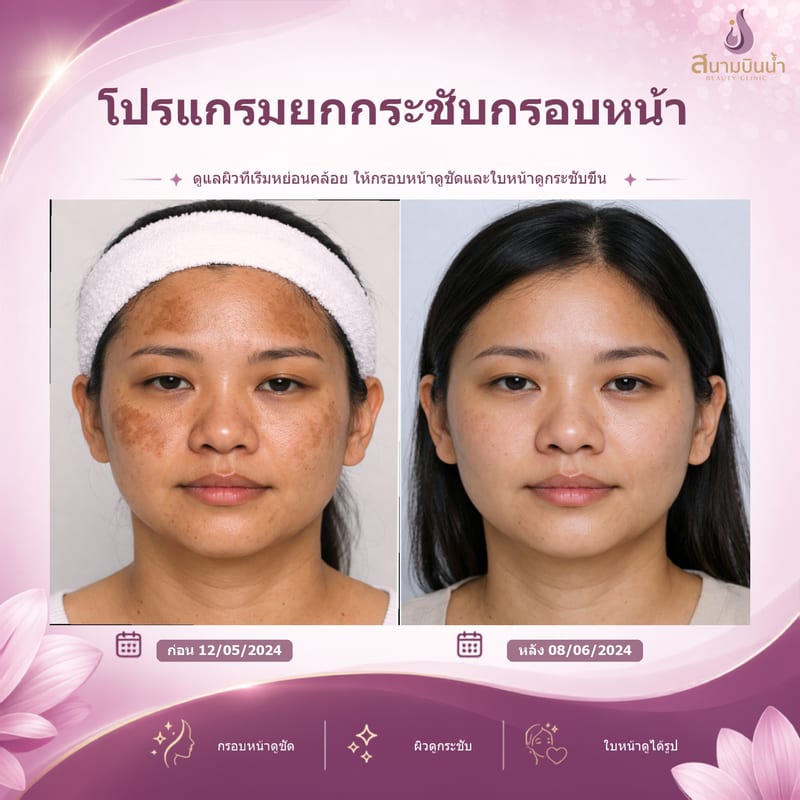 ภาพก่อน–หลัง ยกกระชับกรอบหน้า กรณีเฉพาะบุคคล