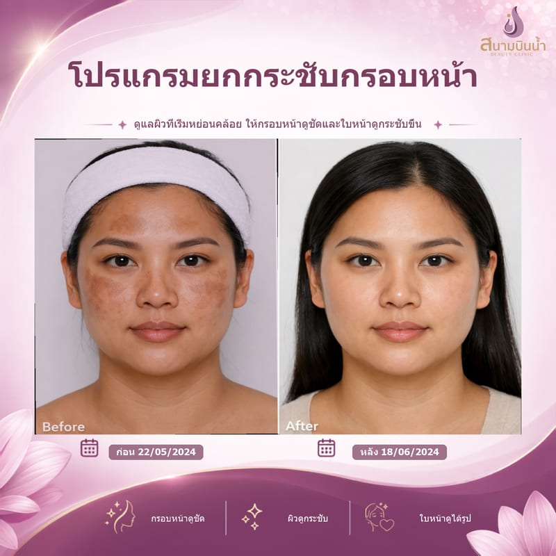 ภาพก่อน–หลัง ยกกระชับกรอบหน้า กรณีเฉพาะบุคคล