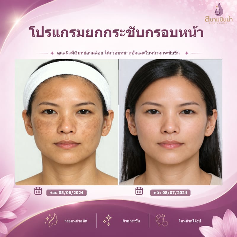 ภาพก่อน–หลัง ยกกระชับกรอบหน้า กรณีเฉพาะบุคคล