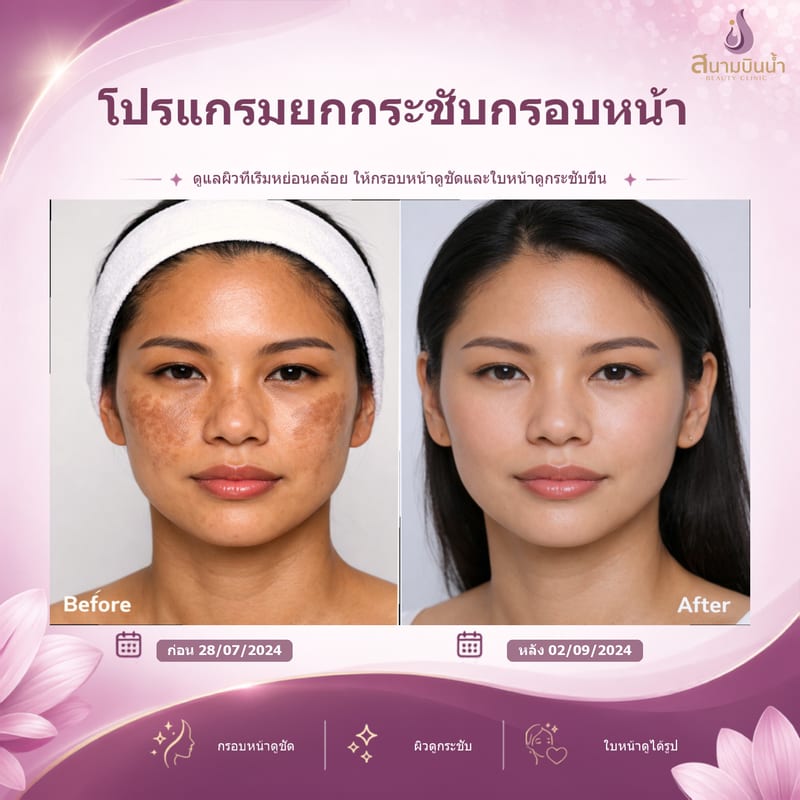 ภาพก่อน–หลัง ยกกระชับกรอบหน้า กรณีเฉพาะบุคคล
