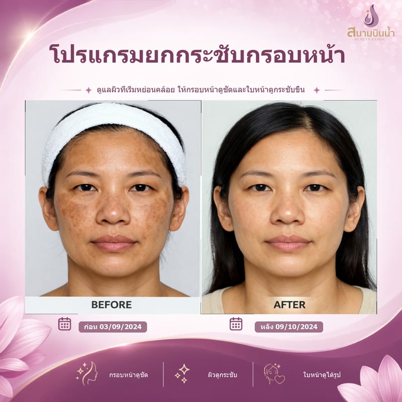 ภาพก่อน–หลัง ยกกระชับกรอบหน้า กรณีเฉพาะบุคคล
