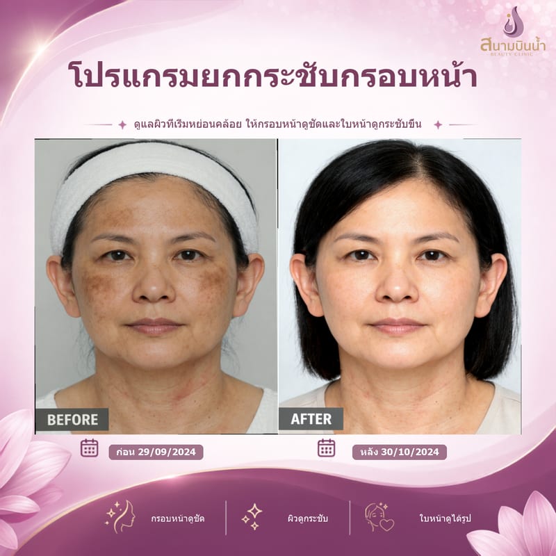 ภาพก่อน–หลัง ยกกระชับกรอบหน้า กรณีเฉพาะบุคคล