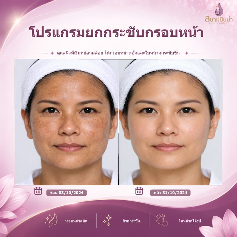 ภาพก่อน–หลัง ยกกระชับกรอบหน้า กรณีเฉพาะบุคคล