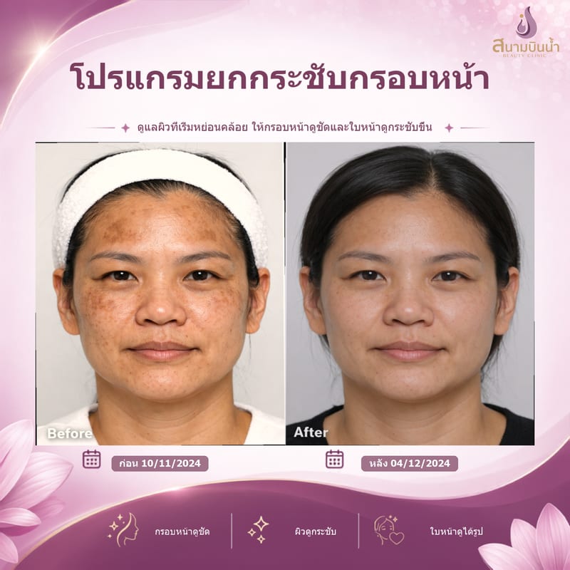 ภาพก่อน–หลัง ยกกระชับกรอบหน้า กรณีเฉพาะบุคคล