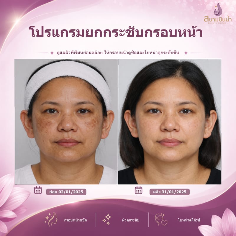 ภาพก่อน–หลัง ยกกระชับกรอบหน้า กรณีเฉพาะบุคคล