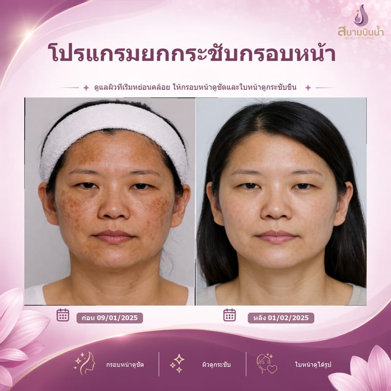 ภาพก่อน–หลัง ยกกระชับกรอบหน้า กรณีเฉพาะบุคคล