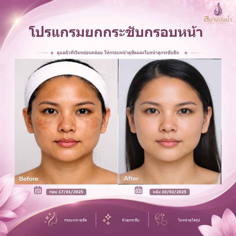 ภาพก่อน–หลัง ยกกระชับกรอบหน้า กรณีเฉพาะบุคคล