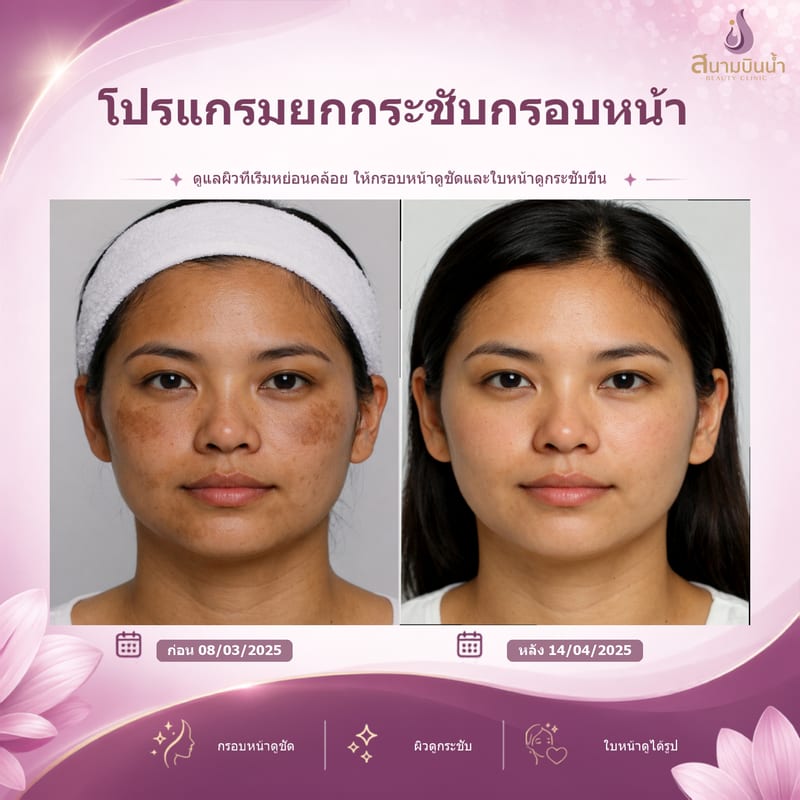 ภาพก่อน–หลัง ยกกระชับกรอบหน้า กรณีเฉพาะบุคคล
