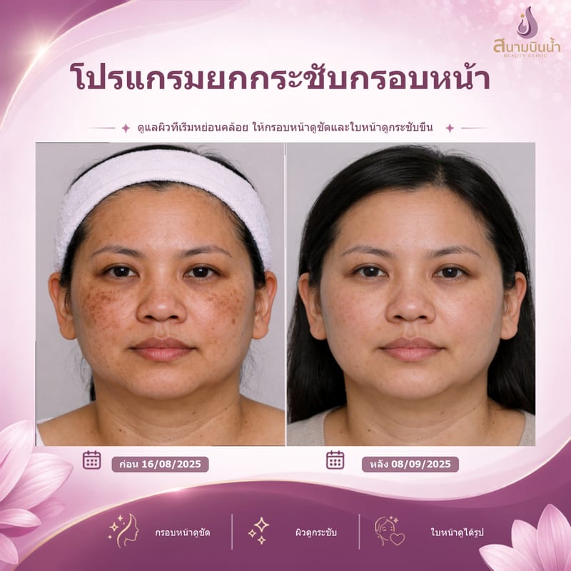 ภาพก่อน–หลัง ยกกระชับกรอบหน้า กรณีเฉพาะบุคคล