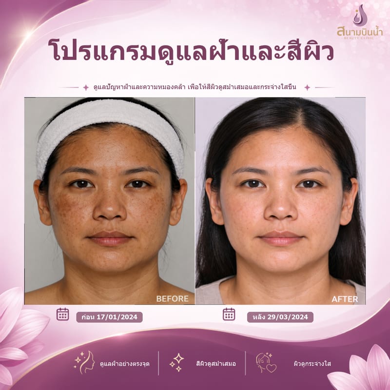 ภาพก่อน–หลัง รักษาฝ้า กรณีเฉพาะบุคคล
