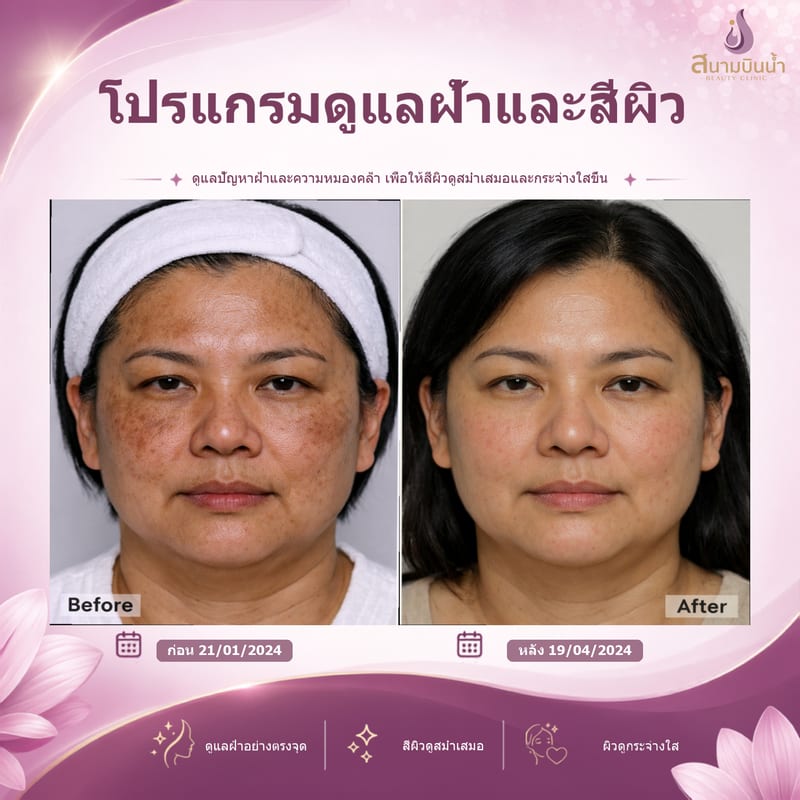 ภาพก่อน–หลัง รักษาฝ้า กรณีเฉพาะบุคคล