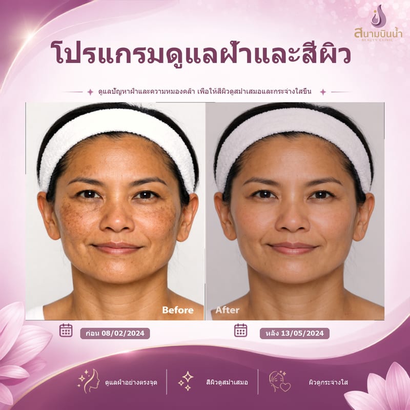 ภาพก่อน–หลัง รักษาฝ้า กรณีเฉพาะบุคคล