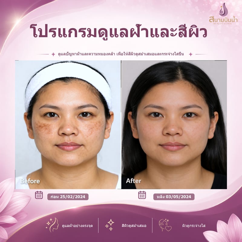 ภาพก่อน–หลัง รักษาฝ้า กรณีเฉพาะบุคคล