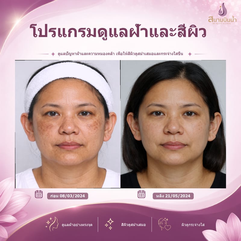 ภาพก่อน–หลัง รักษาฝ้า กรณีเฉพาะบุคคล