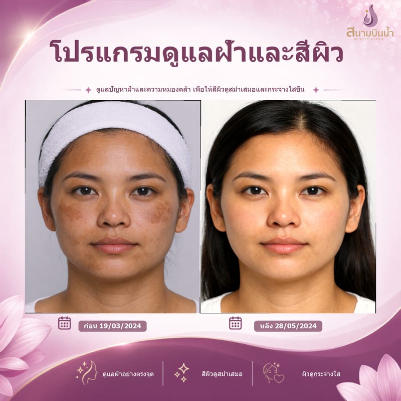 ภาพก่อน–หลัง รักษาฝ้า กรณีเฉพาะบุคคล
