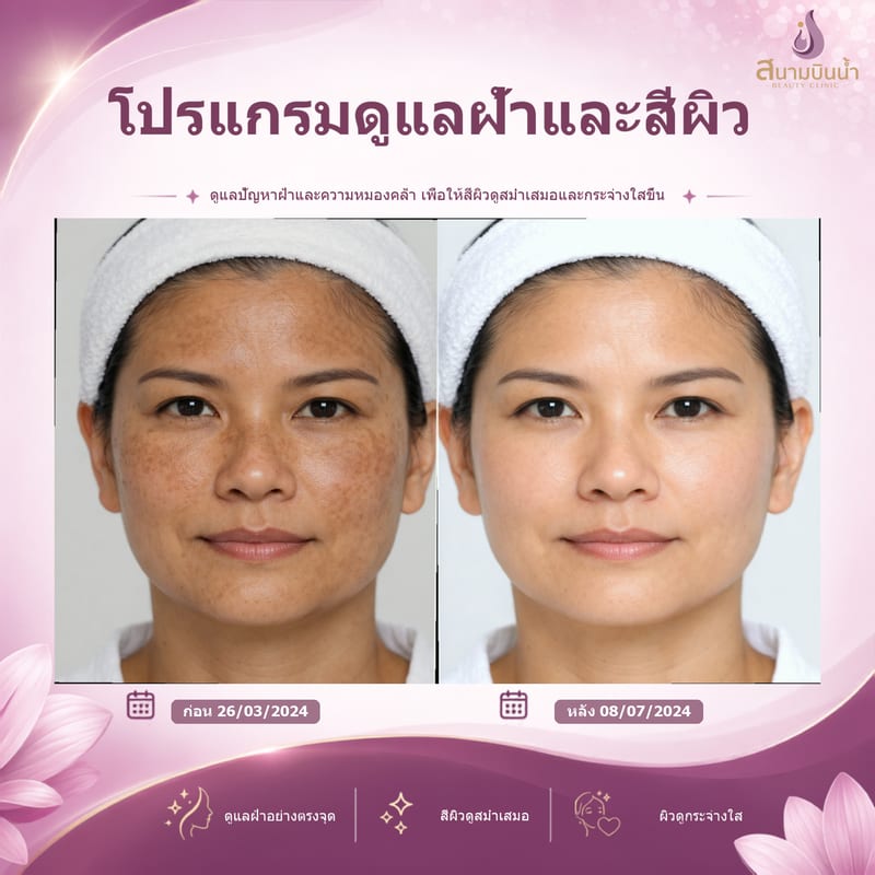 ภาพก่อน–หลัง รักษาฝ้า กรณีเฉพาะบุคคล