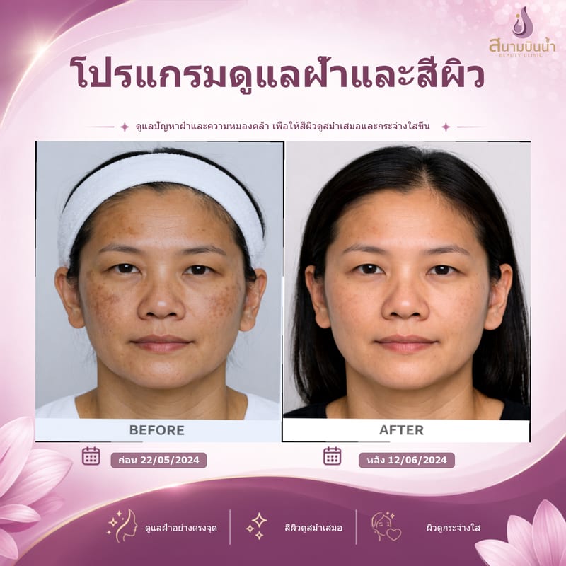 ภาพก่อน–หลัง รักษาฝ้า กรณีเฉพาะบุคคล